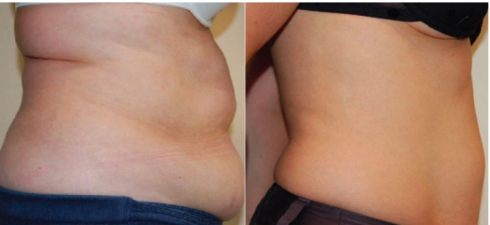 Before / After