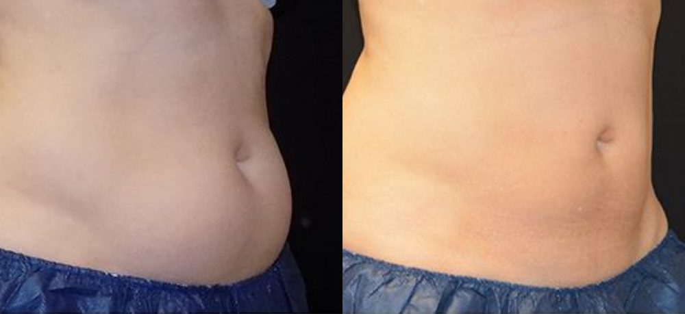 Before / After