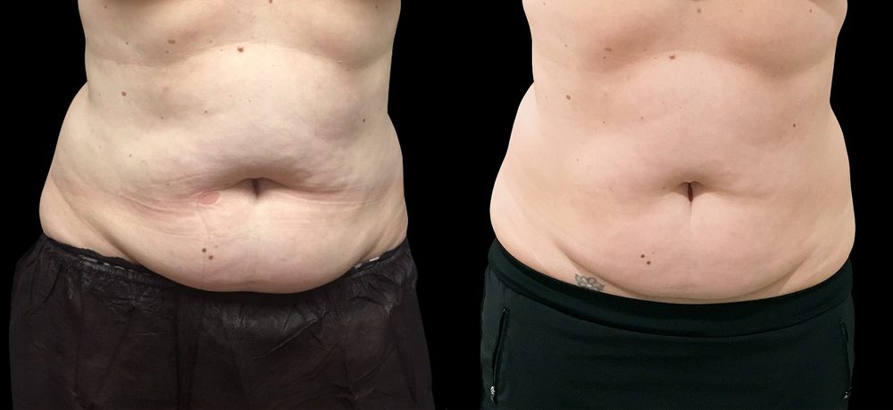 Before / After