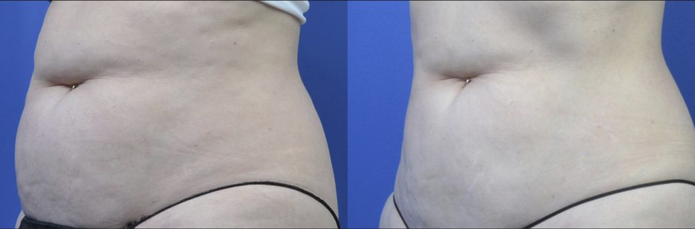Before / After