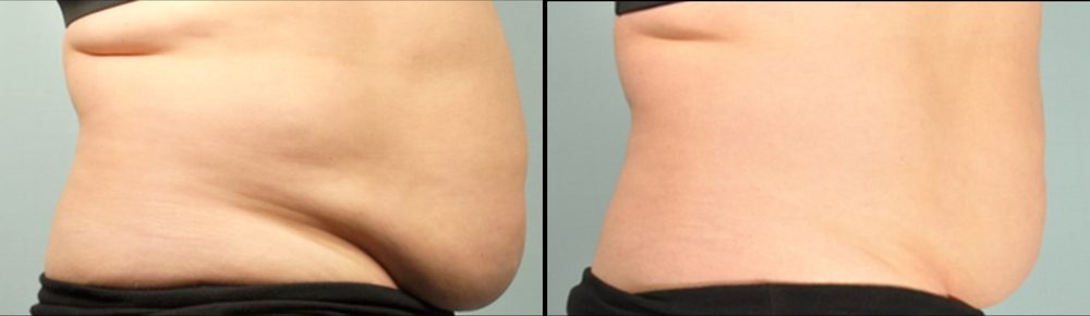 Before / After